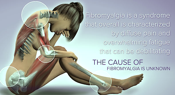 Fibromyalgia nerve pain