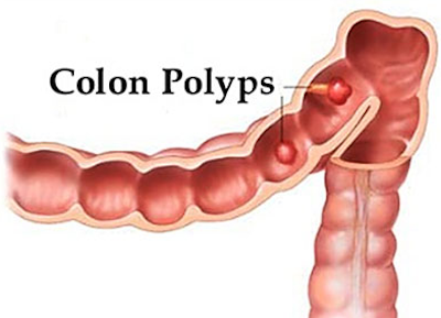 Polyps Colon Warts