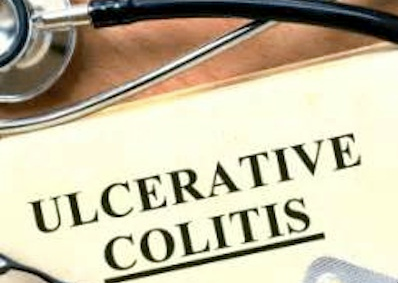 Ulcerative Colitis Ulcers Story