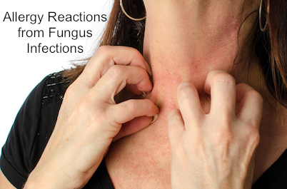 Fungus Infection