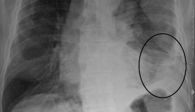 malignant pleural mesothelioma chest xray