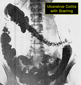 ulcerative colitis ulsers and scarring xray
