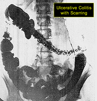 ulcerative colitis ulsers and scaring xray