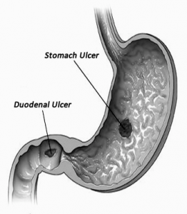 stomach ulcer and colitis disease