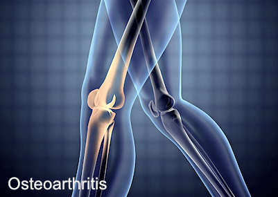 What Is Osteoarthritis?