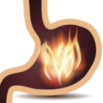 gastritis inflammation of the stomach